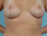 Patient # 27994 After Photo # 2